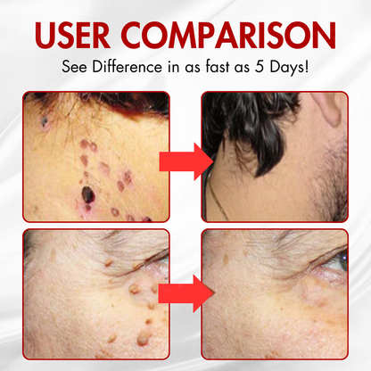 🏆AEXZR® Nano-Microdart Skin Tag & Spot Corrector Patches