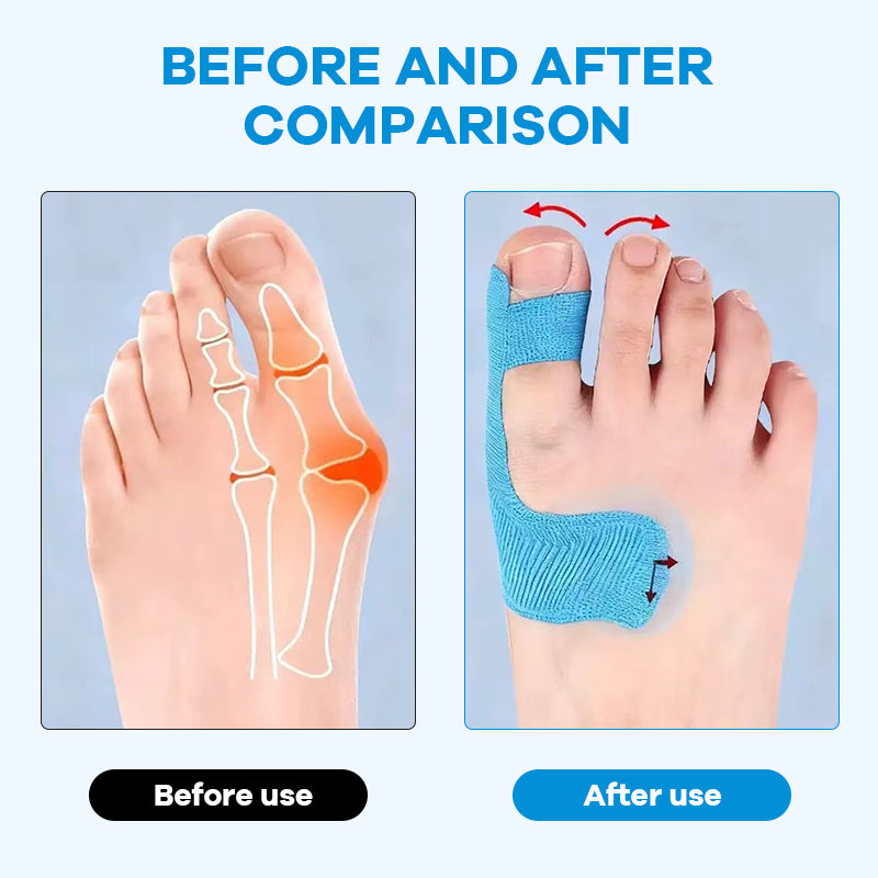 🏆Medical-Grade Bunion Tape – 🦶Hypoallergenic, Breathable, Painless Removal👟